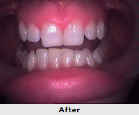 Teeth Whitening Treatment in India