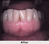 Tooth Whitening in India